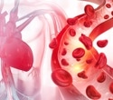 Uterine fibroids linked to higher long-term heart disease risk in women