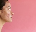 Study reveals widespread unrecognized acne among 35-year-old Finnish women