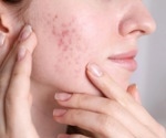 Study identifies 29 new genetic variants linked to acne