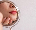 Study reveals widespread unrecognized acne among 35-year-old Finnish women