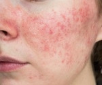Clinicians urged to reconsider controversial acne treatment
