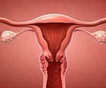 Study: Women with severe endometriosis 10 times more likely to get ovarian cancer
